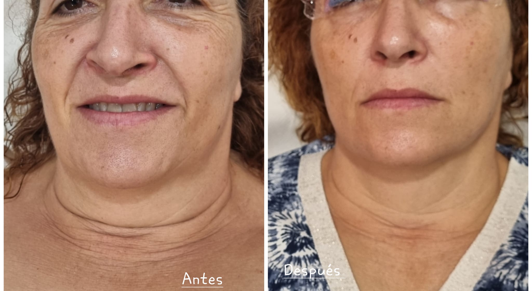 Tratamiento facial