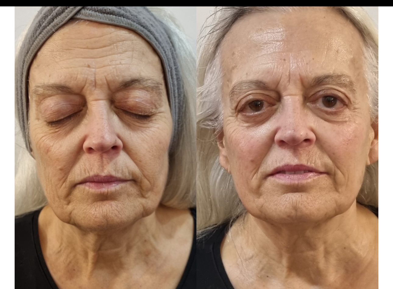 Tratamiento facial
