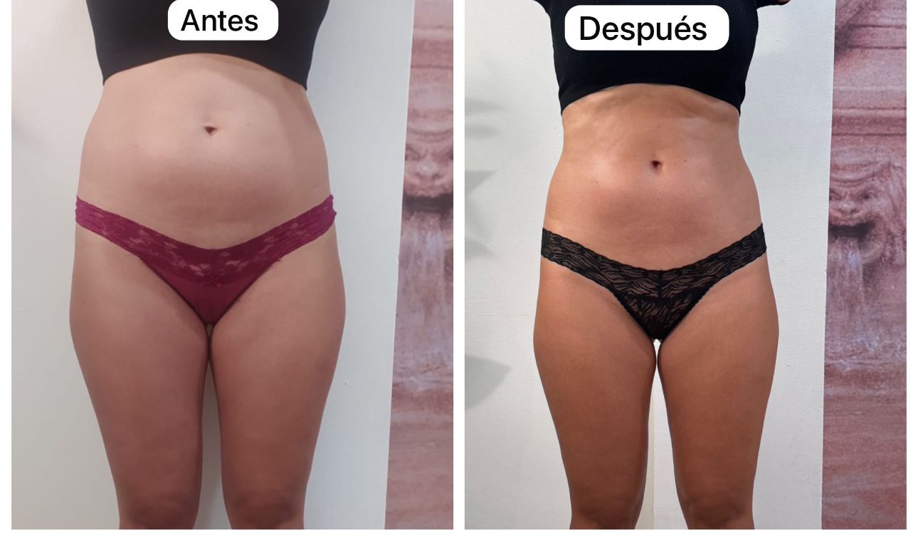 Tratamiento corporal